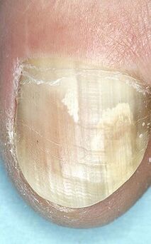 ciuperca unghiilor arată ca stadiul inițial
